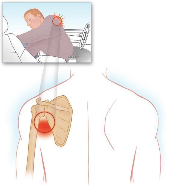 Лечение боли в плече и плечевом суставе 19 Херсон