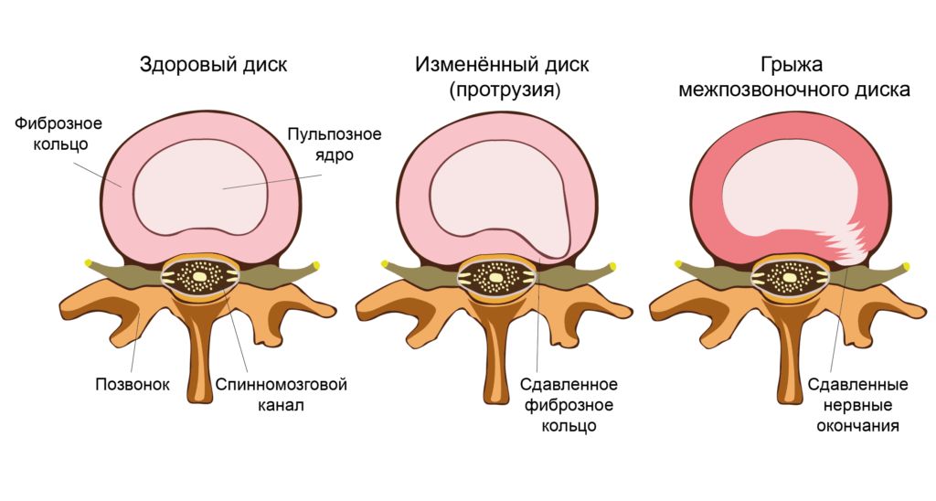 Грыжа межпозвоночного диска: диагностика и лечение в Ярославле